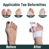 Помагало за Корекција на Палец на Стапала